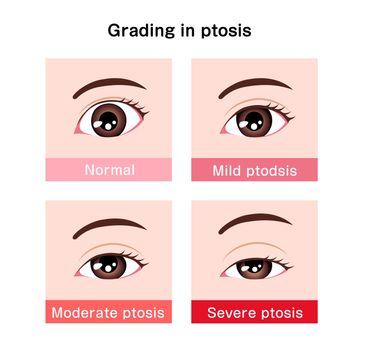 Grading in ptosis vector illustration