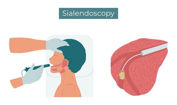 Vector flat illustration of sialendoscopy. Surgery to remove a stone from the duct of the parotid salivary gland.