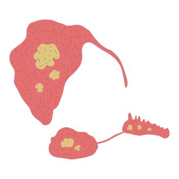 Vector illustration of stones in the salivary glands. Sialolithiasis