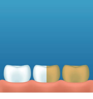 illustration of few teeth yellow color and white on blue background