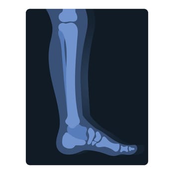 Xray shot of human leg. Medical skeleton test, body radiography cartoon vector illustration