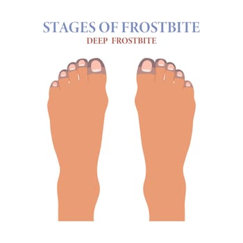 Frozen toes. Stages of frostbite of fingers. Healthcare and medicine. Vector