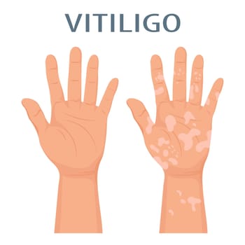 Hands with dermatological disease vitiligo. Medicine concept. Banner, poster, vector