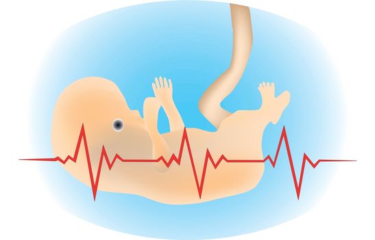 Illustration featuring a tiny premature baby with electrocardiogram signal