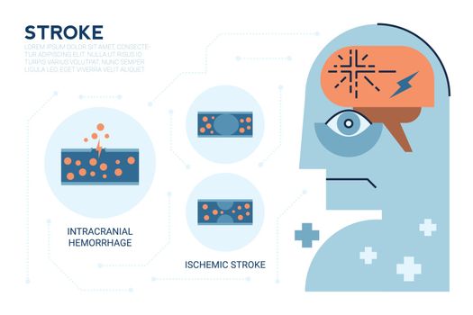 Illustraiton of Stroke brain disease, Cerebrovascular Disease (CVD), Cerebrovascular Accident (CVA), Brain attack
