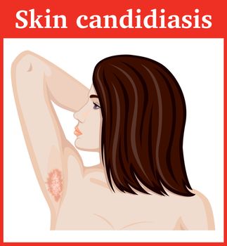 Girl with symptoms of skin candidiasis in the armpits