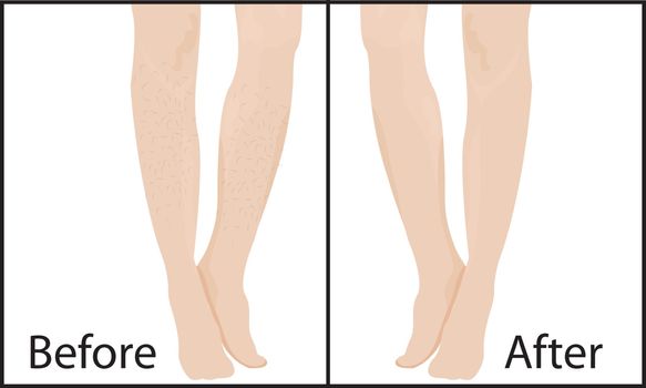 Before and after Hair removal methods and results