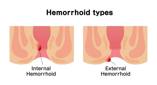 Types of Hemorrhoid flat vector illustration