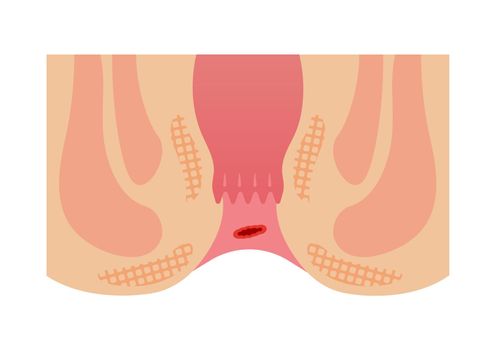 Type of Hemorrhoid flat vector illustration / bleeding hemorrhoids