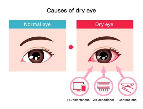 Causes of dry eye vector illustration