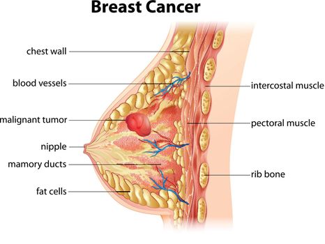Cross section showing formation of breast cancer