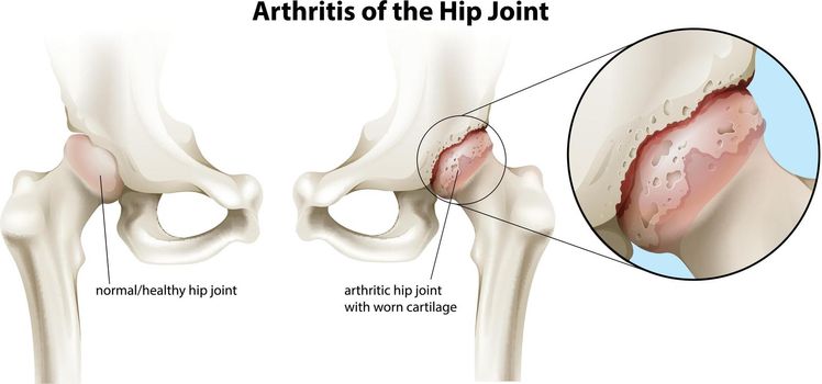 Illustration of the arthritis of the hip joint on a white background