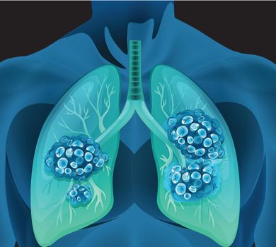 Lung cancer in human body illustration