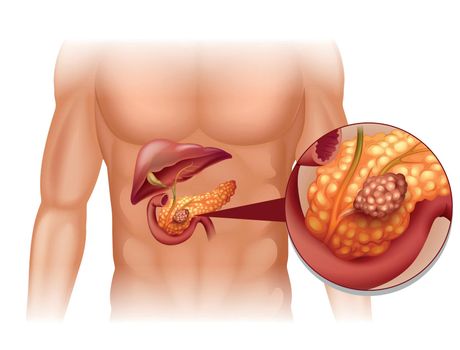 Pancreas cancer in human body illustration