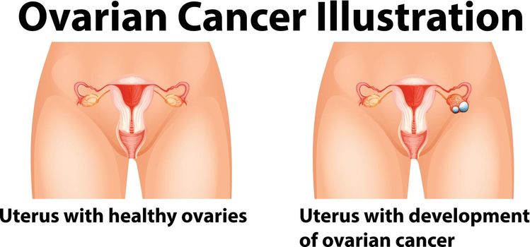 Diagram showing ovarian cancer in human illustration