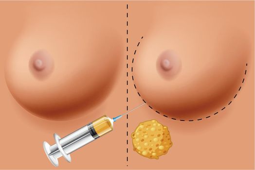 A Vector of Breast Surgery illustration