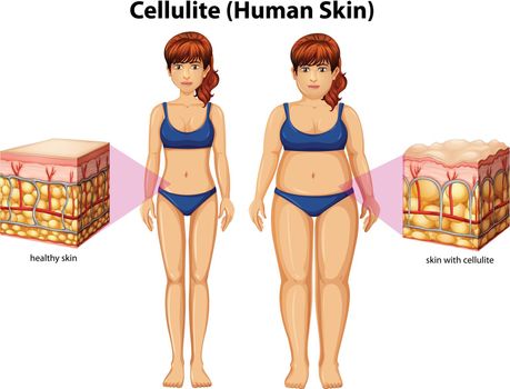 A Comparison of Women with Cellulite illustration