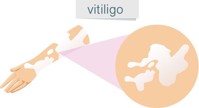A Vector of Vitiligo on Skin illustration