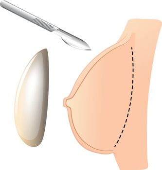Breast augmentation with implant and knife illustration