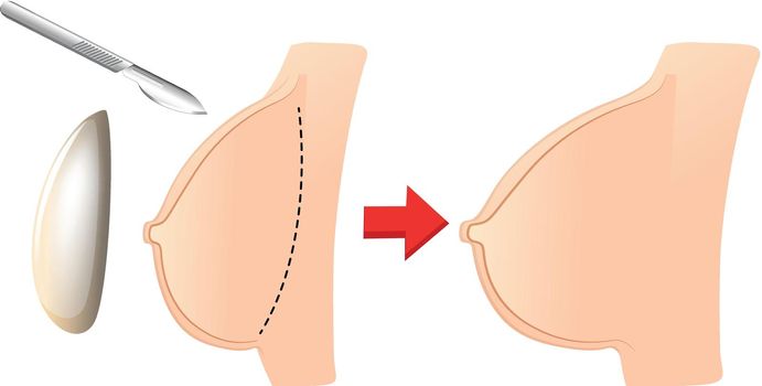 A Set of Breast Augmentation illustration