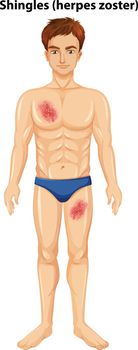 A man skin with shingles illustration