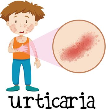 A Vector of Skin Urticaria illustration