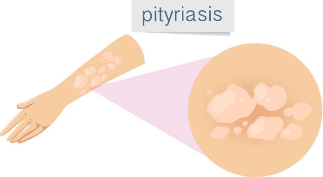 A Pityriasis on Human Skin illustration