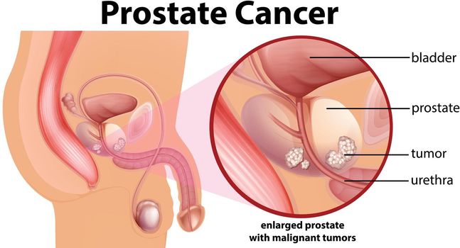 Diagram of prostate cancer illustration
