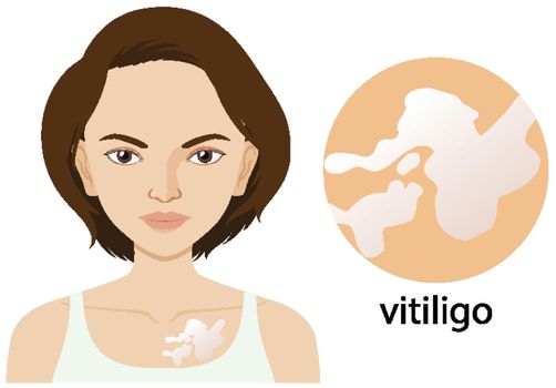 Woman with vitiligo condition illustration