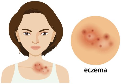 Woman and eczema problem illustration
