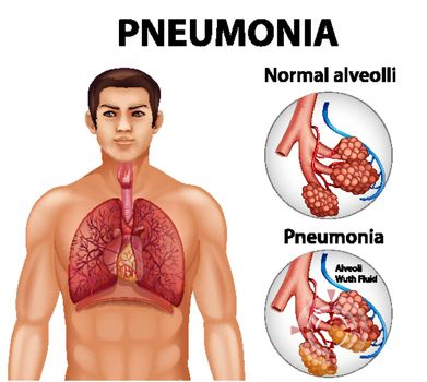 Comparison of healthy alveoli and Pneumonia illustration