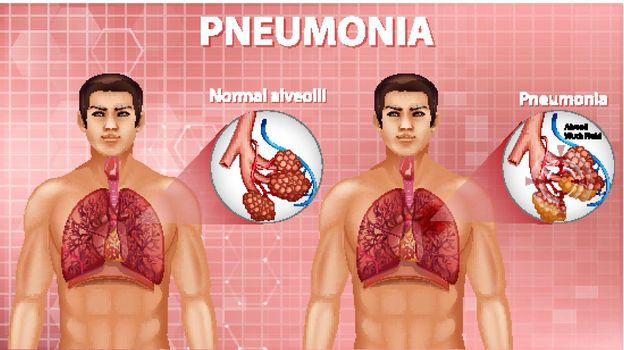 Comparison of healthy alveoli and Pneumonia illustration