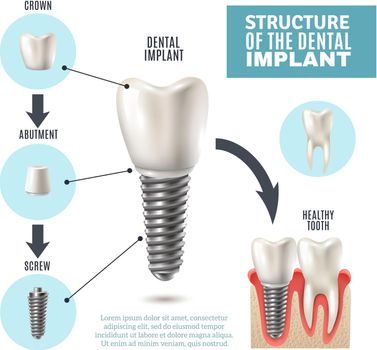 Dental implant structure medical pictorial educative infographic poster with molar replacement end healthy tools models vector illustration 