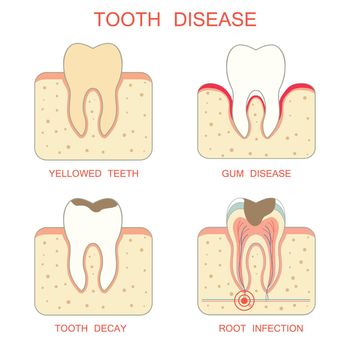 tooth decay disease,periodontal gum, yellowed teeth, root infection
