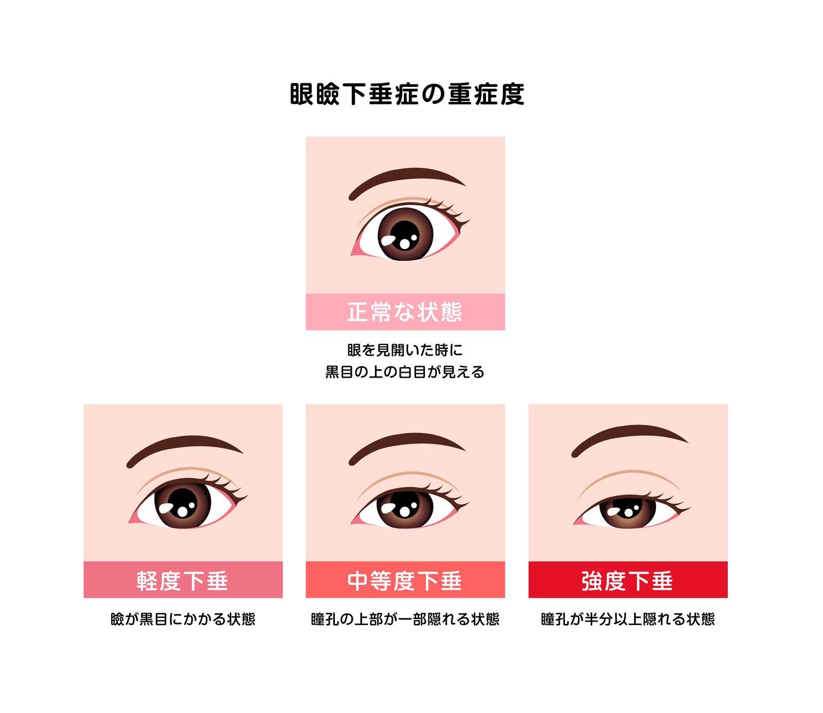 Grading in ptosis vector illustration by barks