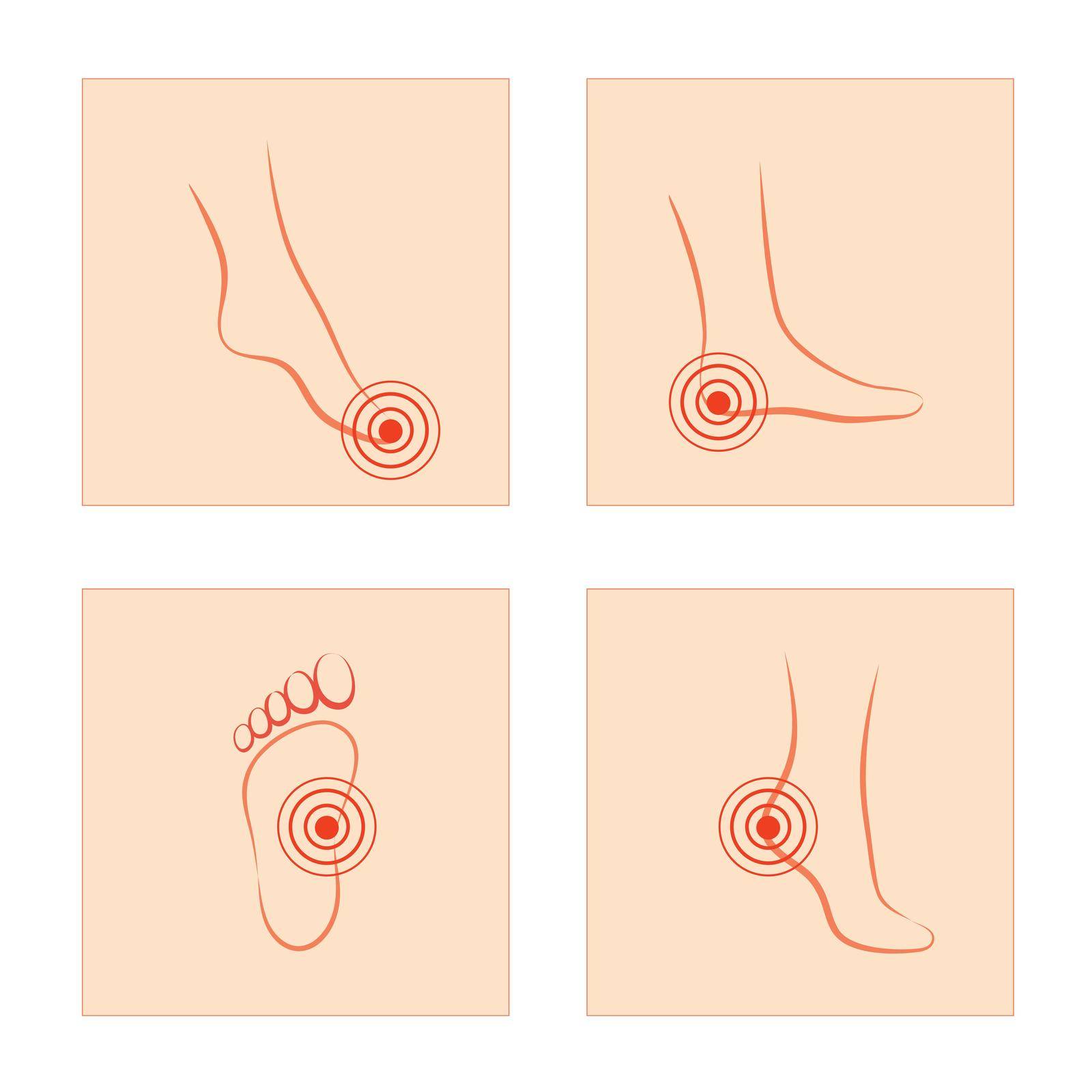 Vector illustration, woman foot pain and toes pain and soles of feet, nerve inflammation disease Concept, vector sketch