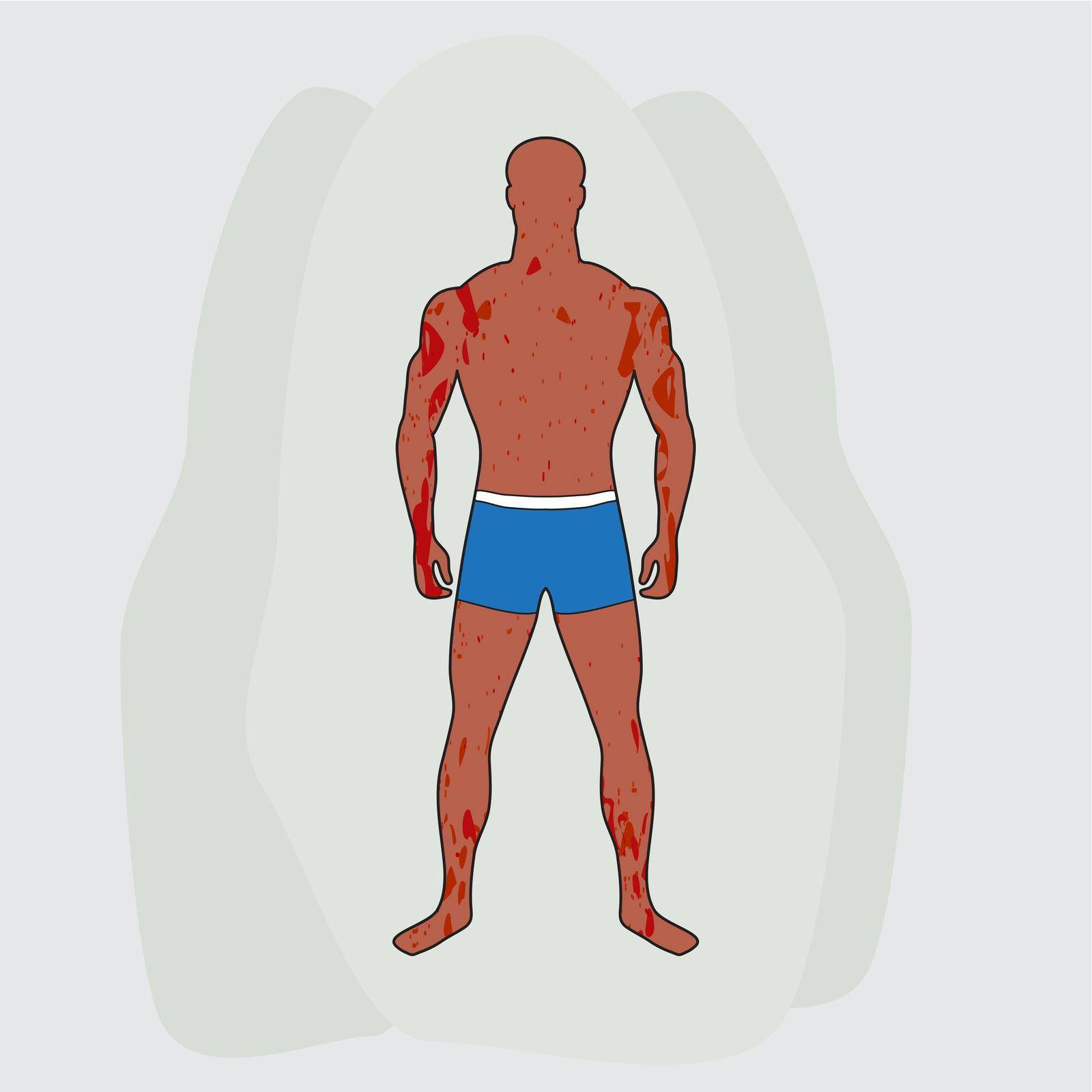 Tanned slender man in blue swimming trunks. Male figure in full growth. Red rash and spots cover whole body. Dermatological disease signs and symptoms. Painful condition of skin. For medical site, app