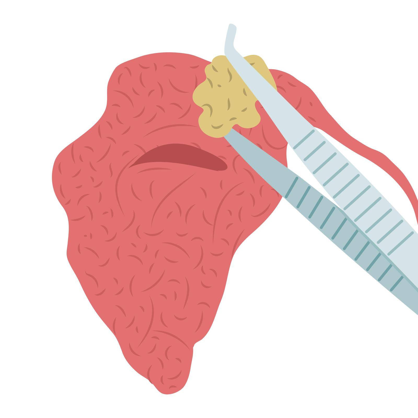 Vector illustration of removing a stone from the parotid salivary gland. Sialolithiasis