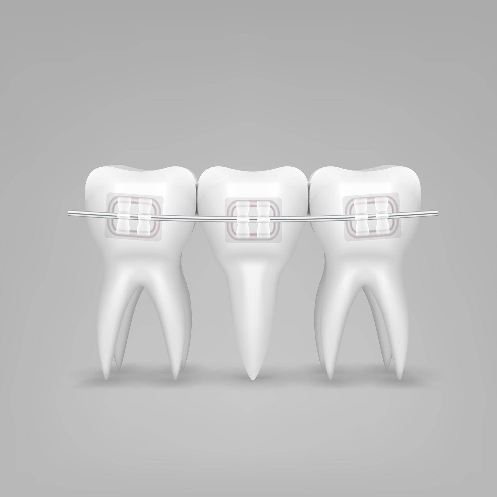 3D White Clear Teeth With Ceramic Braces by VectorThings