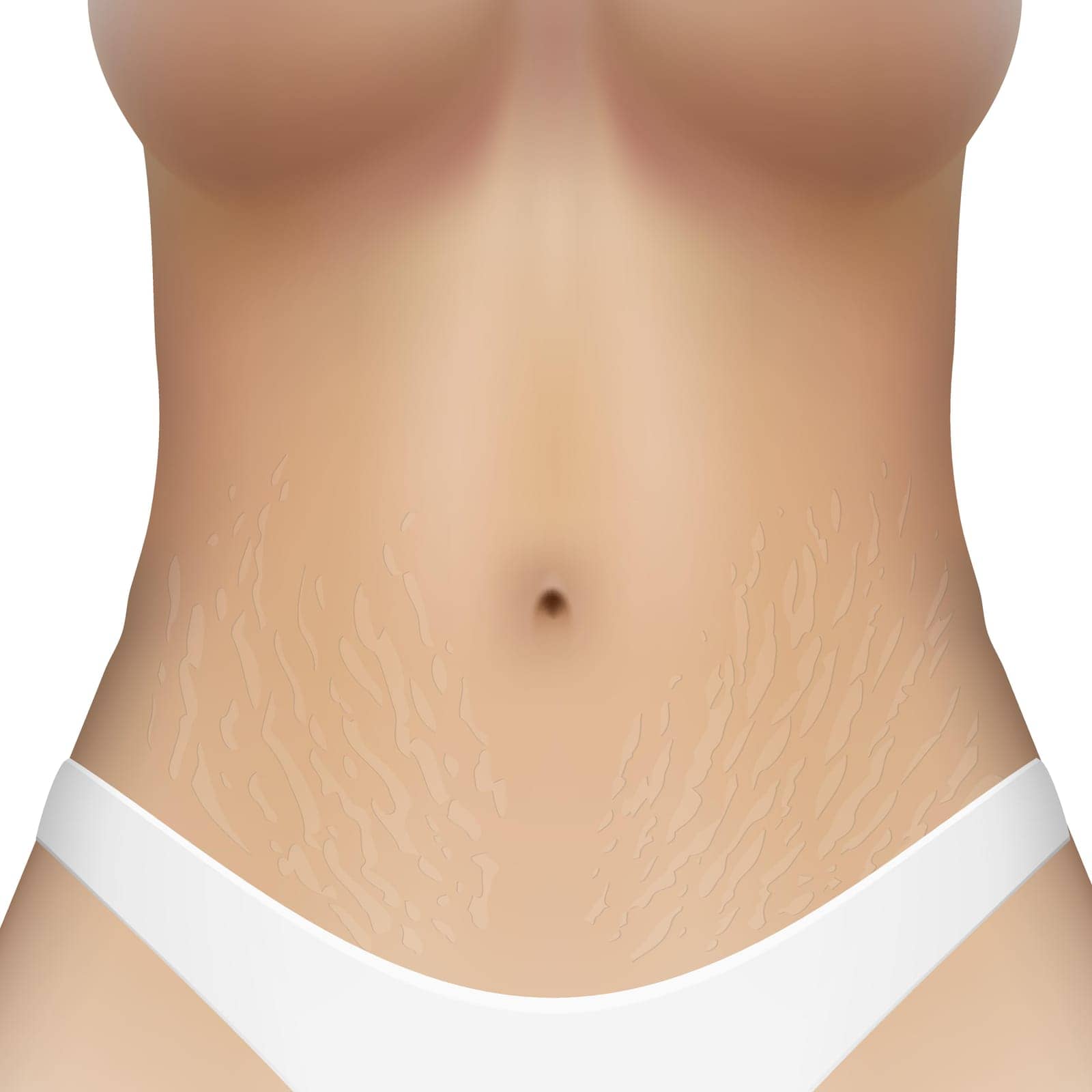 Realistic Woman Body Laser Strechmarks Removal Ad. EPS10 Vector