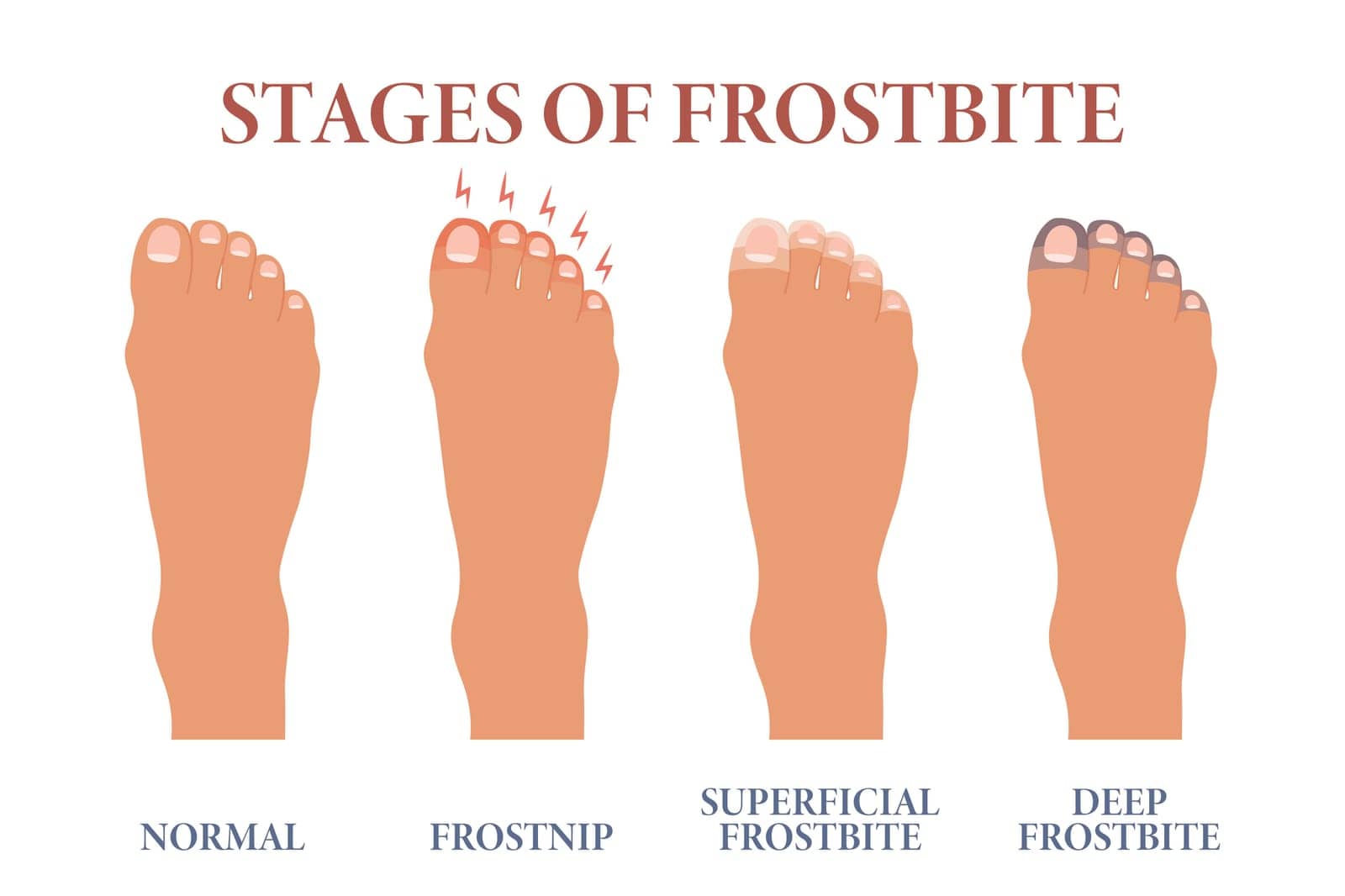 Frozen toes. Stages of frostbite of fingers. Healthcare and medicine. by VS1959