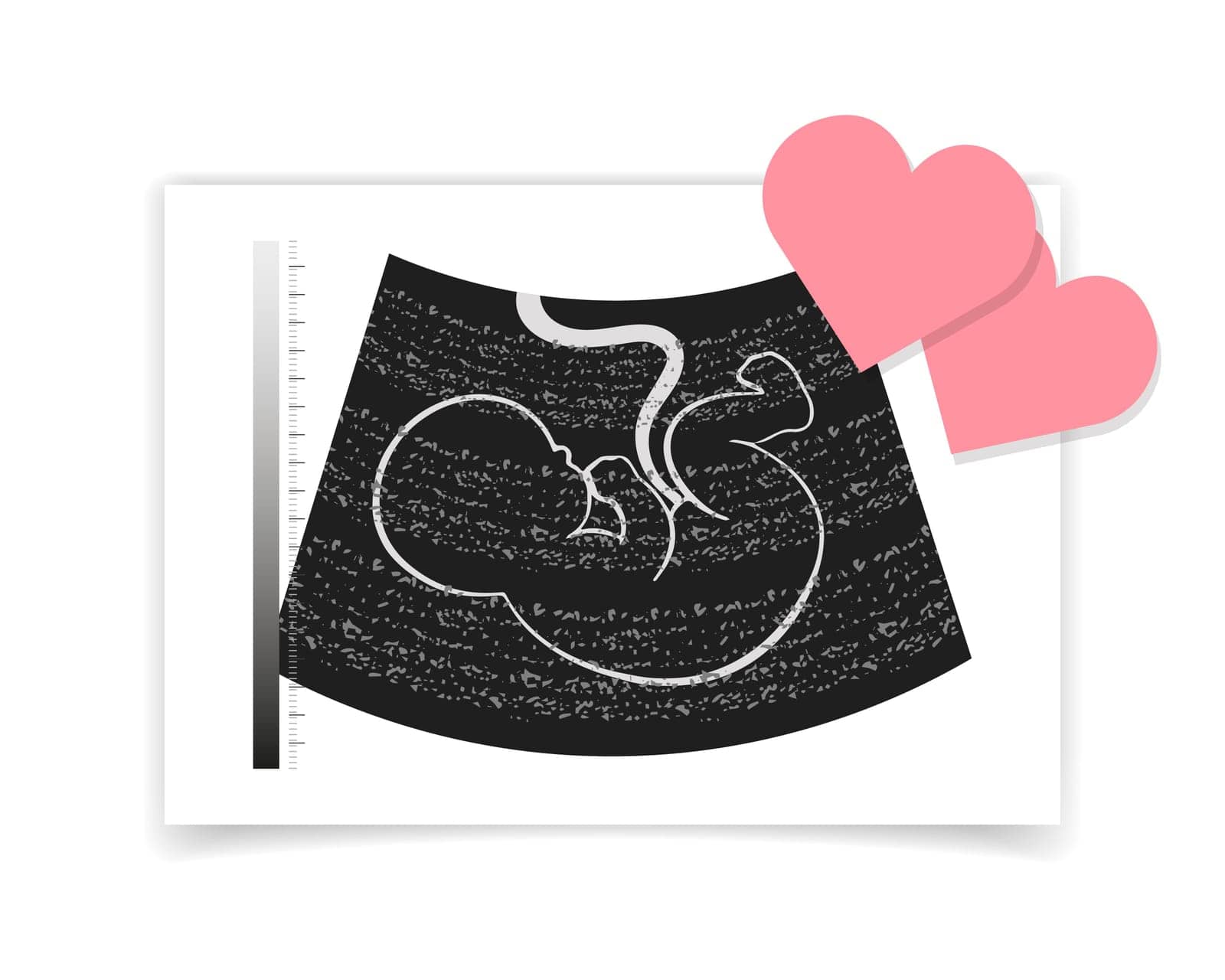 Photograph of an ultrasound of an unborn baby embryo and red hearts. Illustration, postcard, vector