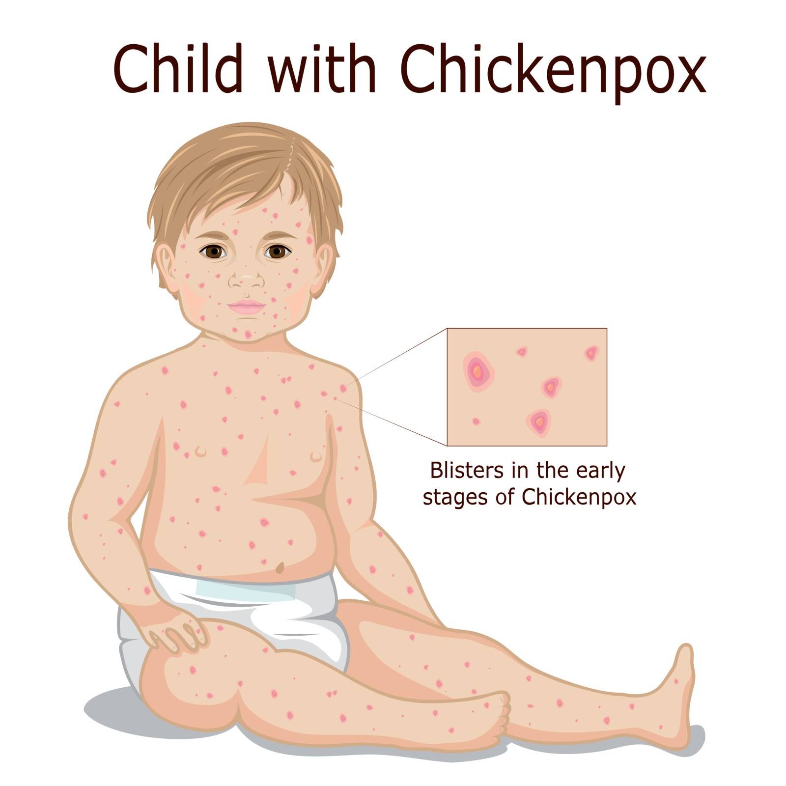 Illustration of child with Chickenpox early stage