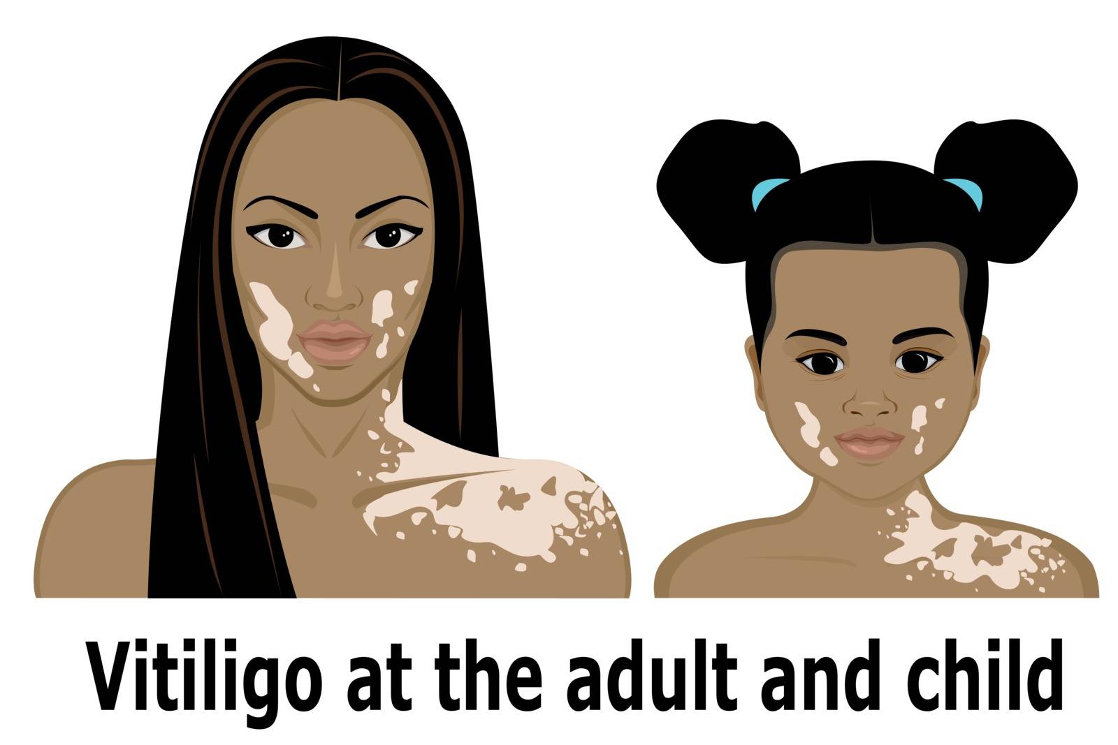 Vitiligo at the woman and the little girl