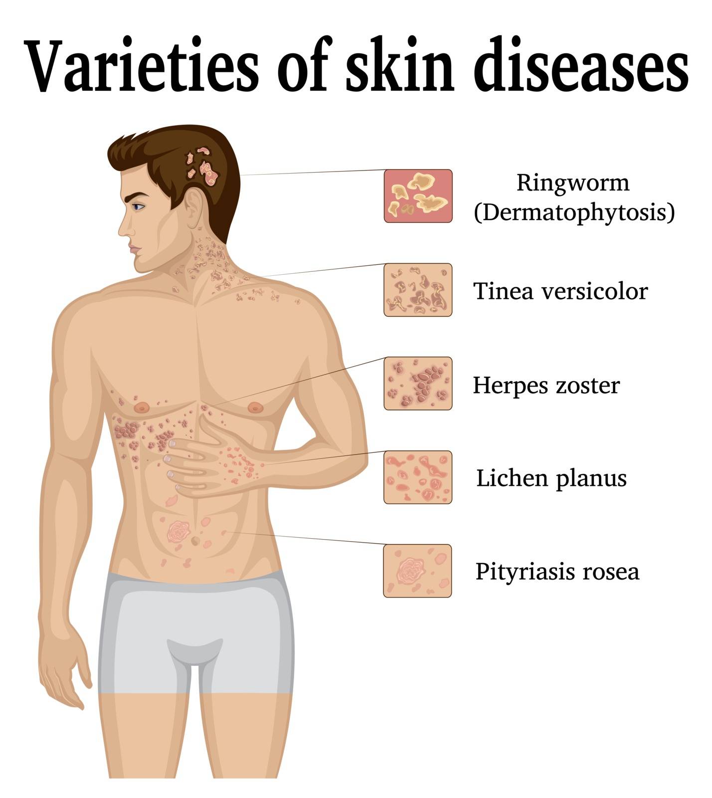 Varieties of skin diseases on the body of a young man