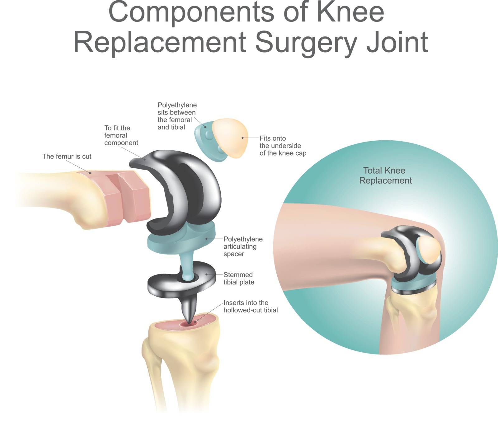 Components of knee replacement surgery joint. Health care. Anatomy body human.