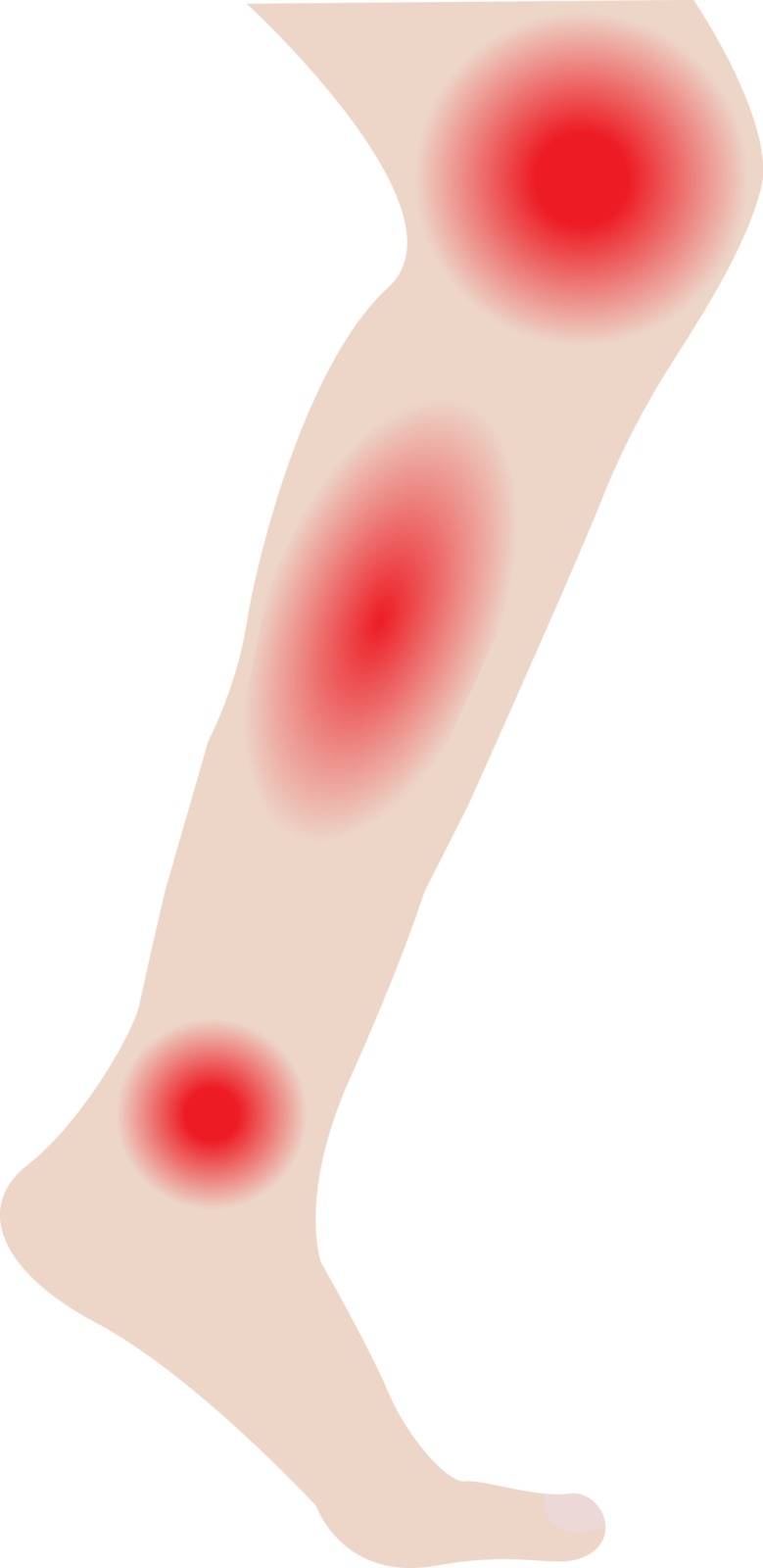 Swelling of the leg and ankles from infected or injury vector illustration on a white background