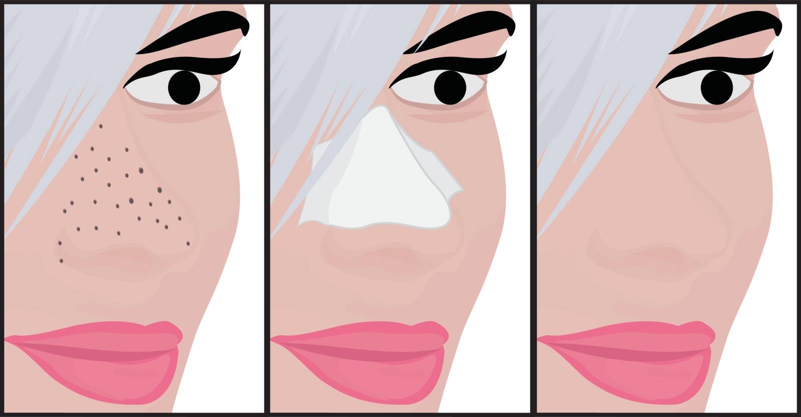 Blackheads on Nose vector illustration showing skin problems