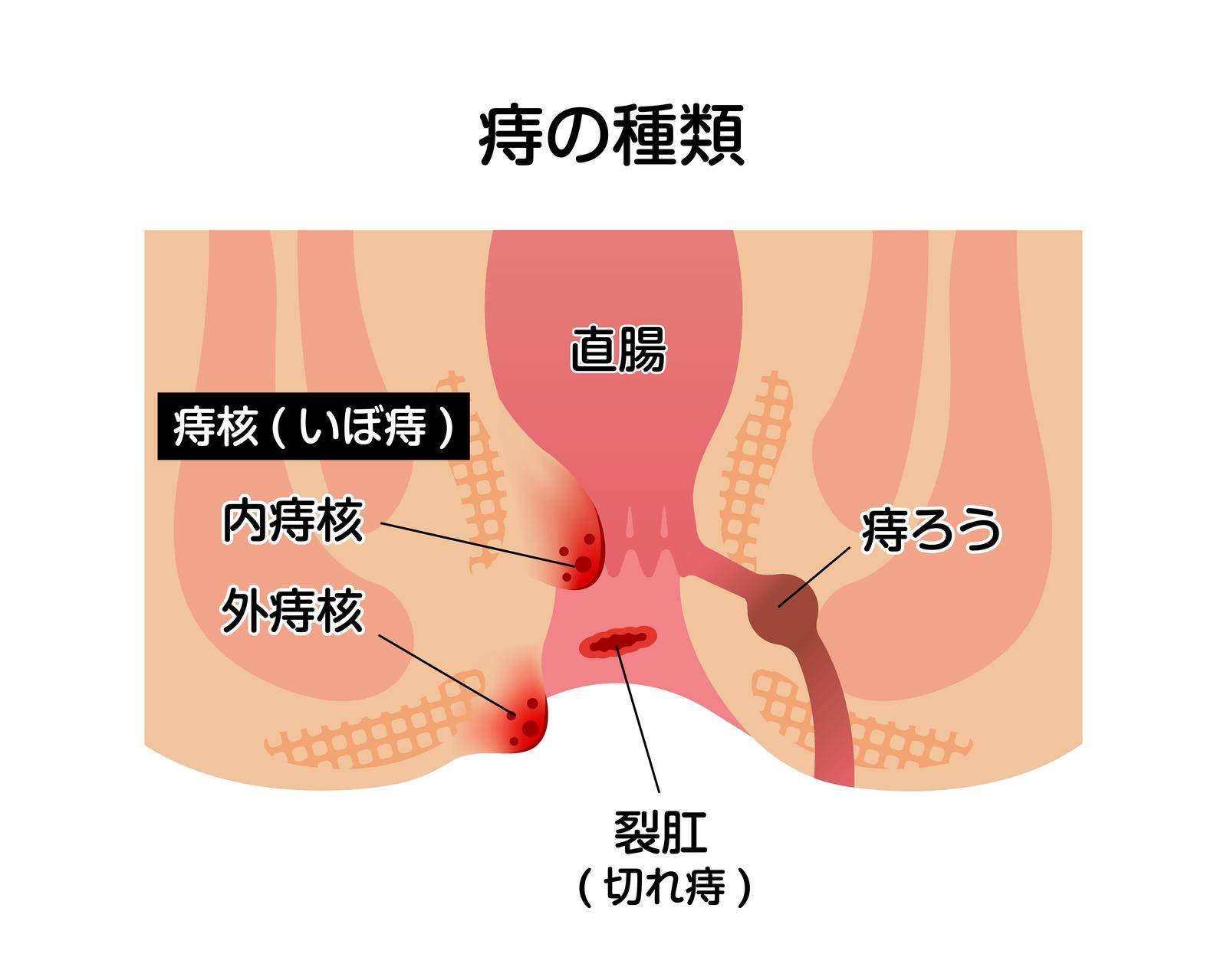 Types of Hemorrhoid flat vector illustration ( Japanese )