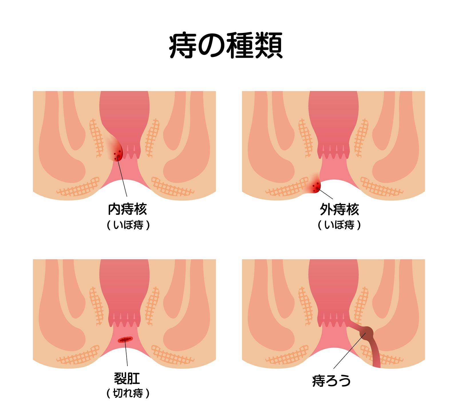 Types of Hemorrhoid flat vector illustration ( Japanese)